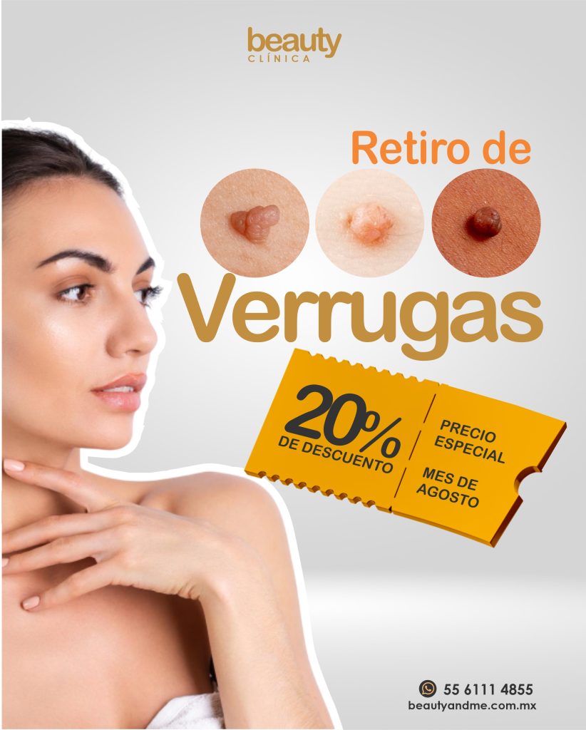 Retiro de verrugas