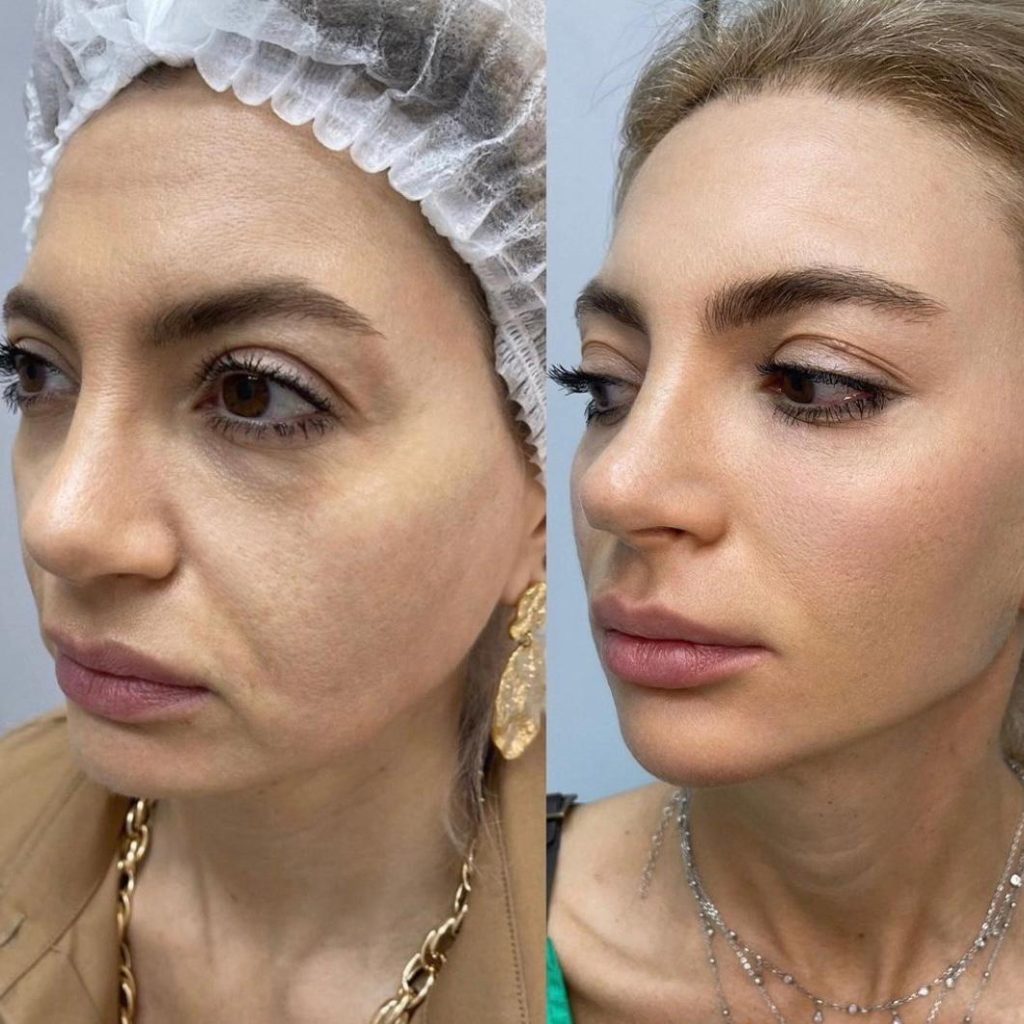 Armonización Facial