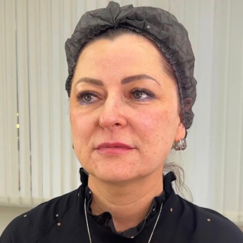 Armonización Facial Armonización Facial